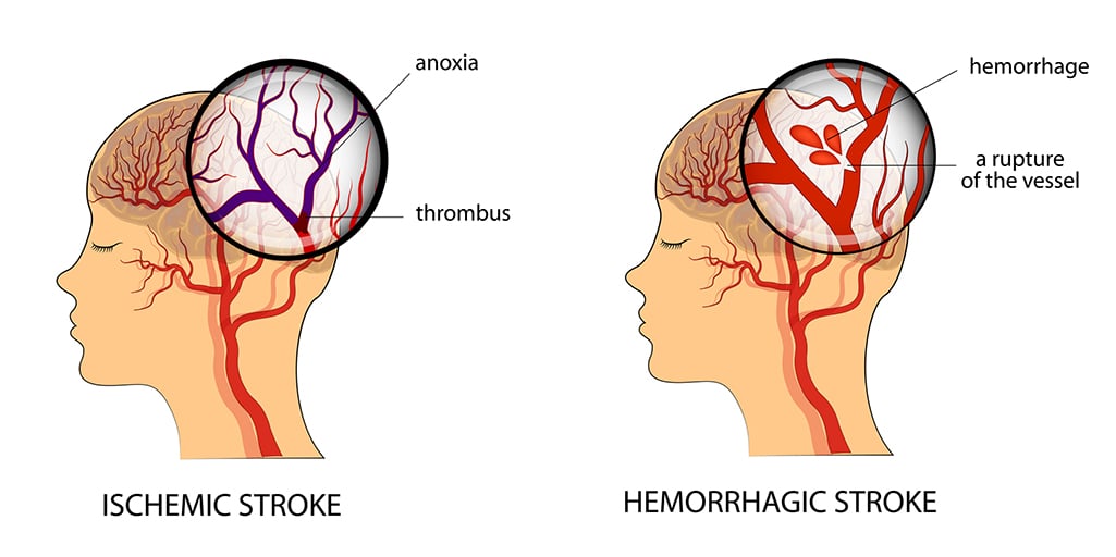 ISCHEMIC versus HEMORRHAGIC STROKE graphic